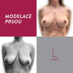 Modelace prsou - MUDr. Lubor Mrňa