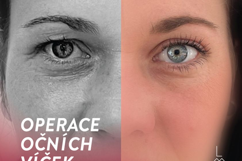 Operace očních víček před a po - 859489