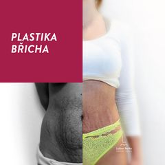 Abdominoplastika - MUDr. Lubor Mrňa