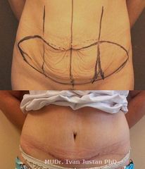 1 abdominoplasty 04a