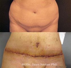 1 abdominoplasty 05a