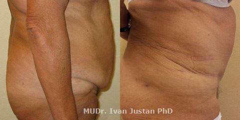 1 abdominoplasty 08c