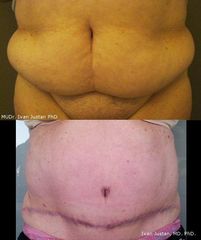 abdominoplastika2