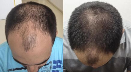 Před a Po-kombinace vlasové plasma terapii a mezo terapii-Aether Clinic Prague