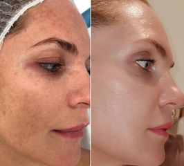 IPL + ResurFx - Aether Esthetic and Beauty Clinic Prague