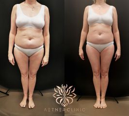 Neinvazivní liposukce - Aether Esthetic and Beauty Clinic Prague