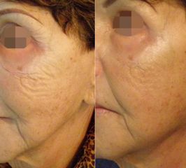 RF Microneedling - Aether Esthetic and Beauty Clinic Prague
