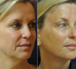Ultherapy - Aether Esthetic and Beauty Clinic Prague