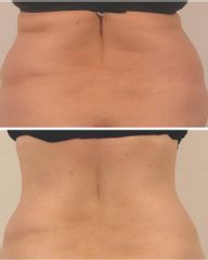 RF-lifting se stimulaci svalu DMA -Aether Aesthetic and Beauty Clinic