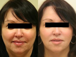 Ultherapy (SMAS-Lifting) - Aether Aesthetic and Beauty Clinic