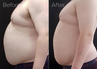 BEFORE neinvazivni laserova liposukce verjú