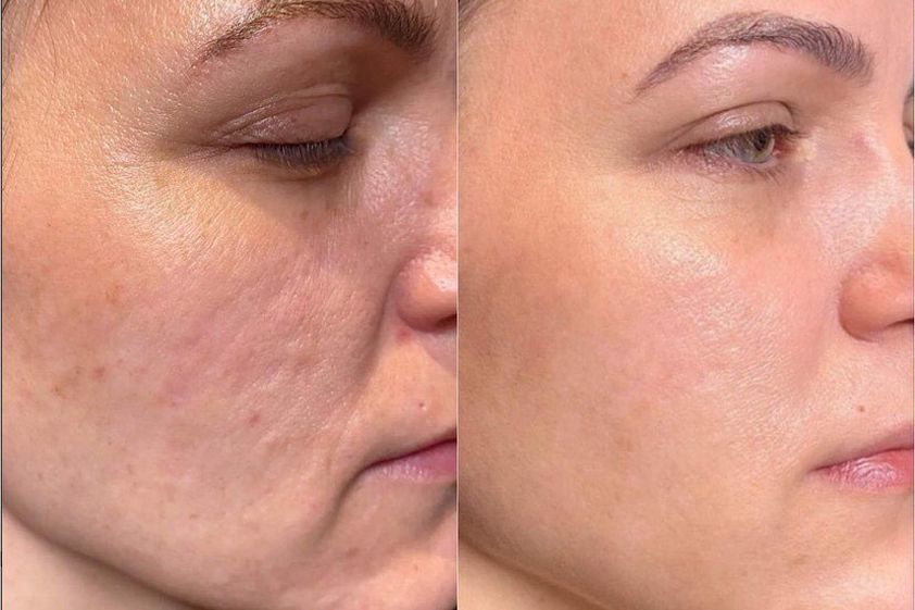 Fotorejuvenace IPL před a po - 846591