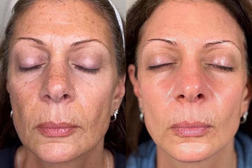 Fotorejuvenace IPL před a po - 846592
