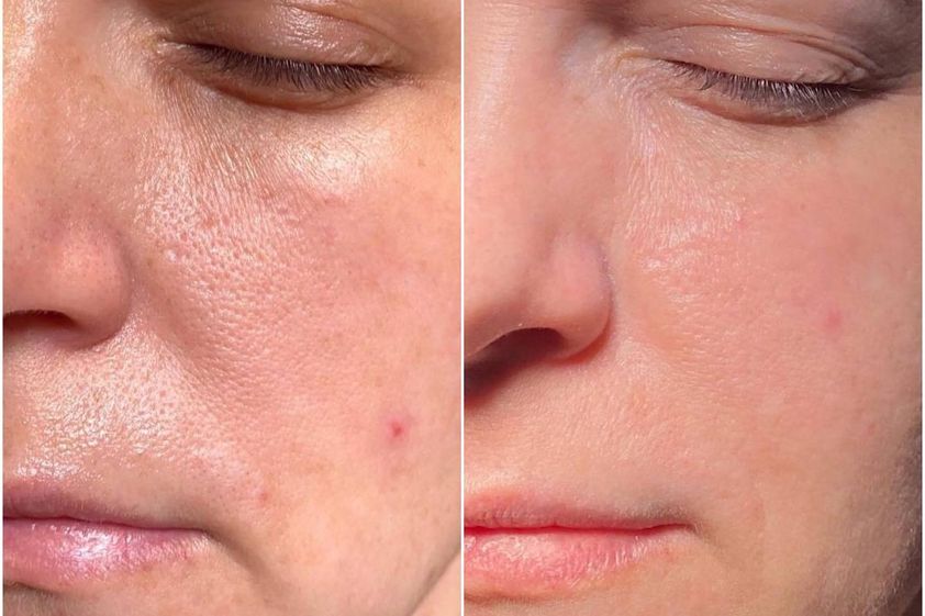 Fotorejuvenace IPL před a po - 846600