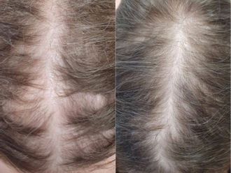 Léčba vypadávání vlasů pomocí plazmaterapie - 846604
