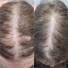 Léčba vypadávání vlasů pomocí plazmaterapie - Aether Aesthetic and Beauty Clinic