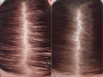 Léčba vypadávání vlasů pomocí plazmaterapie - 846605