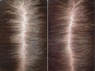 Léčba vypadávání vlasů pomocí plazmaterapie - 846606