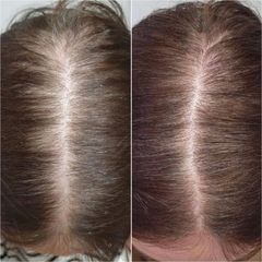 Léčba vypadávání vlasů pomocí plazmaterapie - Aether Aesthetic and Beauty Clinic