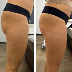 Neinvazivní liposukce - Aether Aesthetic and Beauty Clinic