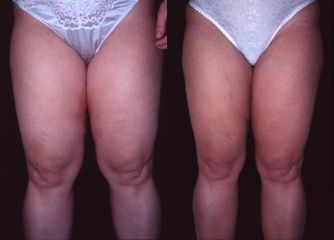 liposukcestehenpred