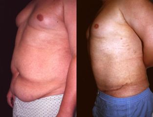 abdominoplastikapred
