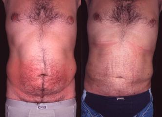 liposukce3pred