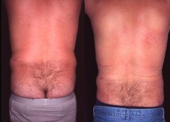liposukce4pred