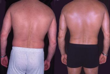 liposukce5pred
