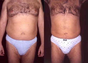07 1 liposukce bricha
