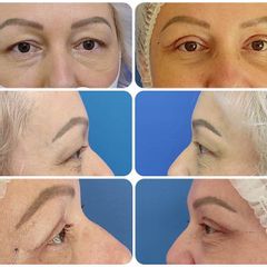Operace očních víček - MUDr. Klosová Hana Ph.D.