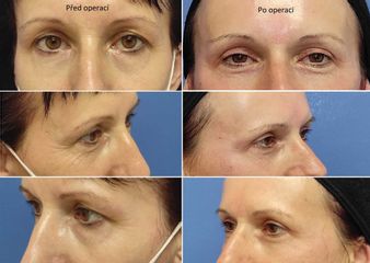 Operace očních víček (Blefaroplastika) -MUDr. Klosová Hana Ph.D.