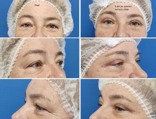 Operace očních víček - MUDr. Klosová Hana Ph.D.