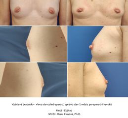 Vpáčené bradavky - MUDr. Klosová Hana Ph.D.