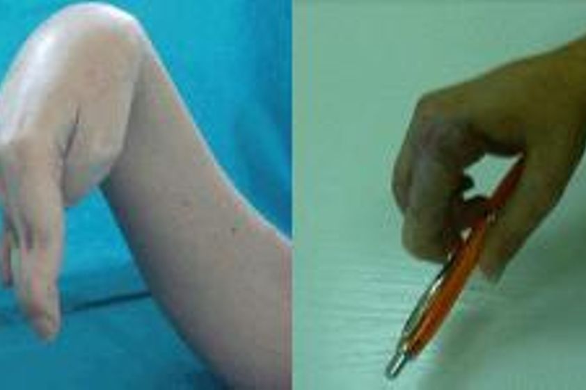 Chirurgie ruky před a po - 729309
