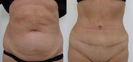 abdomin 1a