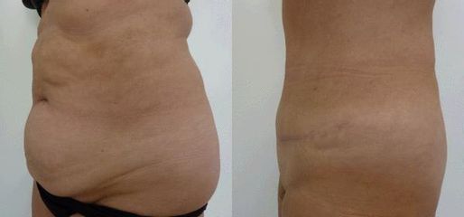 abdomin 2a
