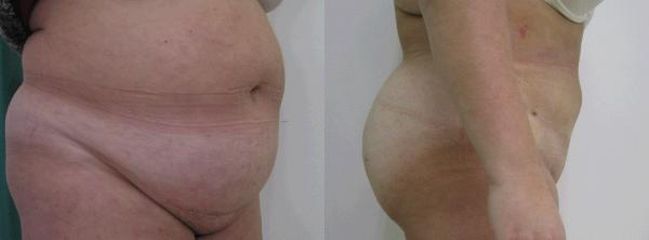 abdomin 3a