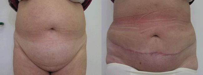 abdomin 4a