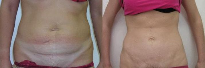 abdomin 6a
