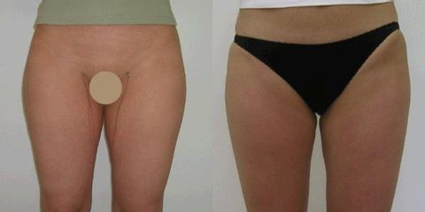 liposukce 4a