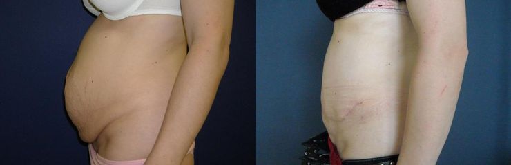 abdomin02a