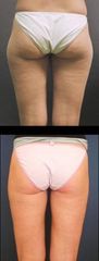 lipo2