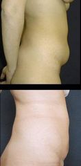 lipo4