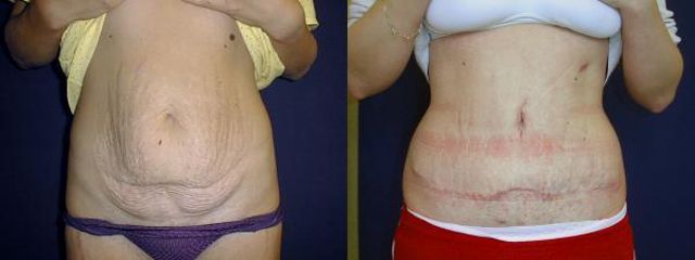 abdominoplastika1a