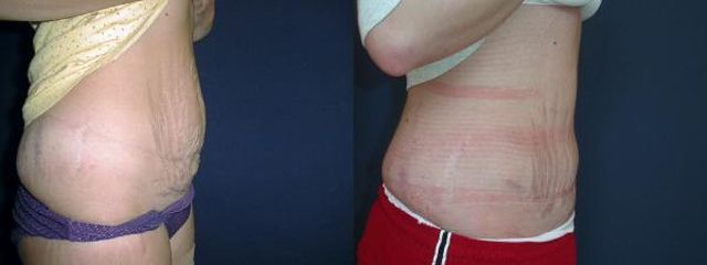 abdominoplastika1b