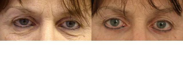 blefaroplastikadv2b