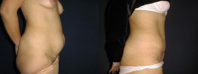 abdominoplastika2a