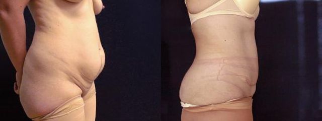 abdominoplastika2b