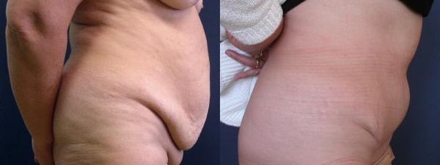 abdominoplastika3b